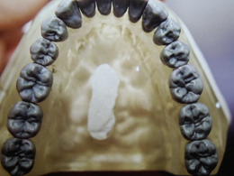 Digitale CAD/CAM Fräsung