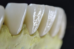 Kronen und Brücken aus Keramik und Zirkon